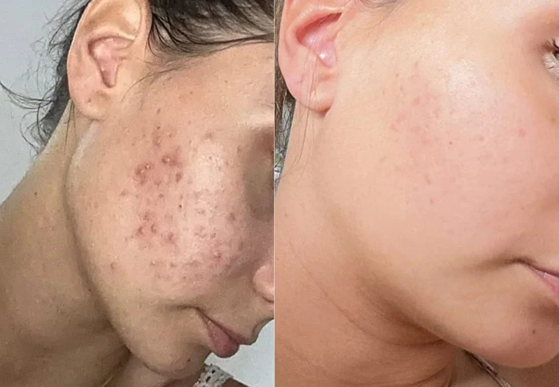 Curcuma et hyperpigmentation : comment agit-il vraiment sur les taches brunes ?
