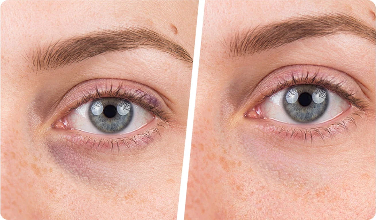 Patch yeux réutilisable ou à usage unique : lequel choisir ? Image