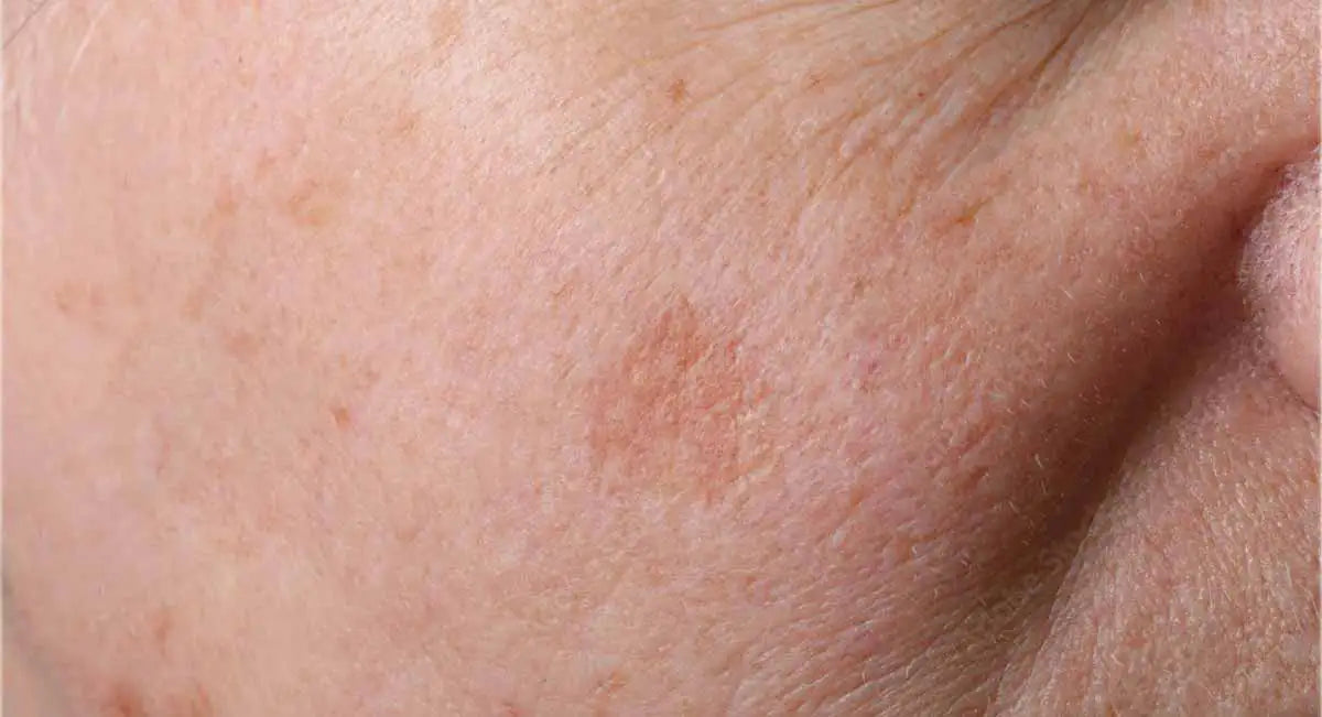 Acide kojique ou curcuma : quel actif choisir contre les taches brunes Image